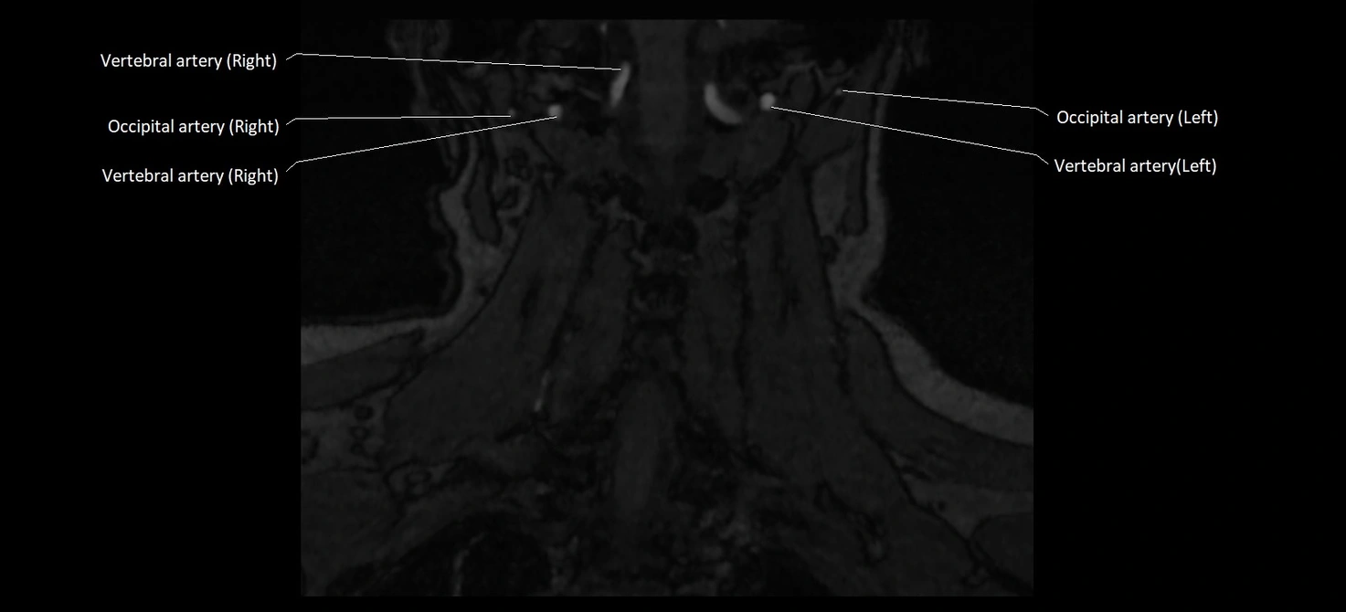 MRA carotid artery anatomy cross sectional 3T coronal image 16.webp